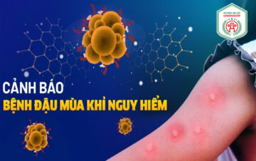 TUYÊN TRUYỀN PHÒNG CHỐNG BỆNH ĐẬU MÙA KHỈ