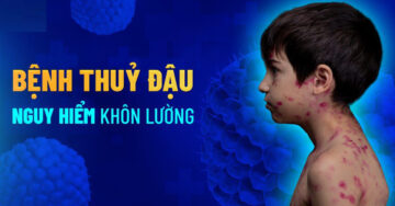 TUYÊN TRUYỀN PHÒNG CHỐNG BỆNH THỦY ĐẬU