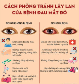 TUYÊN TRUYỀN PHÒNG CHỐNG BỆNH ĐAU MẮT ĐỎ